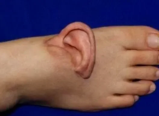 Des médecins greffent temporairement une oreille sur le pied d’une patiente