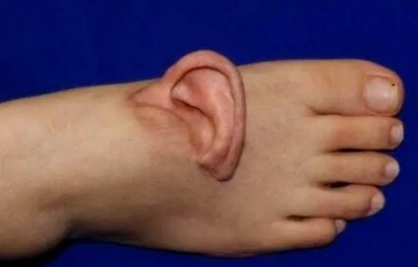 Des médecins greffent temporairement une oreille sur le pied d’une patiente